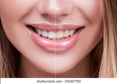 Closeup Mouth open, white Teeth Before and After whitening, big Lips. Female Teeth whitening Before and After the Procedure, straight beautiful Teeth. high quality.  Horizontal image, front view      