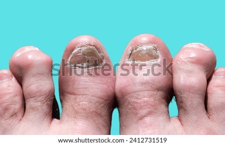 close-up nail fungus on legs. Nail disease.photo of a toenail infection in human. topical antifungal treatment is seen in the big toe of a person suffering from onychomycosis, a fungal infection