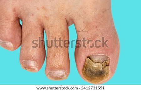 close-up nail fungus on legs. Nail disease.photo of a toenail infection in human. topical antifungal treatment is seen in the big toe of a person suffering from onychomycosis, a fungal infection