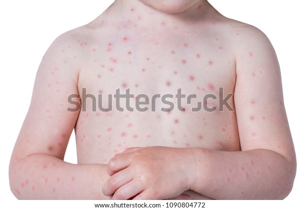 鶏痘のニキビを持つ裸の子供の接写 水疱瘡の子どもの体のにきび の写真素材 今すぐ編集
