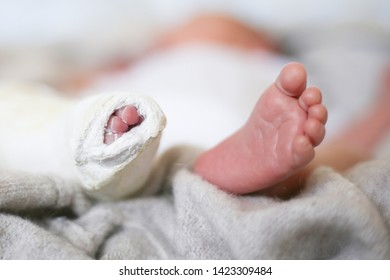 Closeup Of Newborn Little Baby With Leg In A Cast - Clubfoot