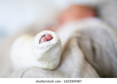 Closeup Of Newborn Little Baby With Leg In A Cast - Clubfoot