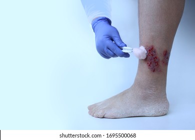 close-up nurse treats a wound on the ankle of the foot with damage to the epidermis, medical concept for the treatment of trophic ulcers