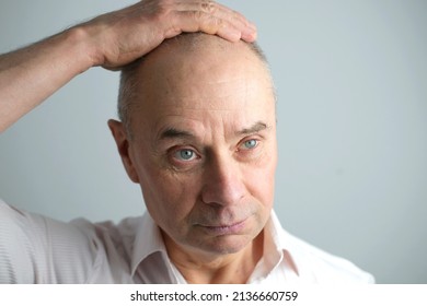 close-up old bald charismatic mature man showing his hair fall from head, patient with alopecia in hair growth clinic, topic of hair loss in men, selective focus. Anti-aging treatments for balding men - Powered by Shutterstock