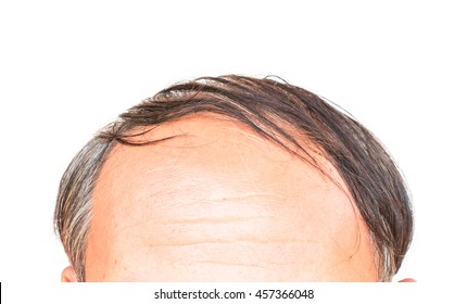 Closeup Old Man Serious Hair Loss And Grey Hair Problem With White Background