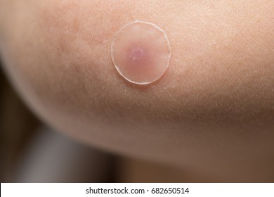 close-up on acne or pimple patch on woman skin
