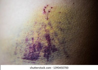  Closeup on a bruise on wounded woman stomach skin. Purple hurt veins. Gender violence concept.
