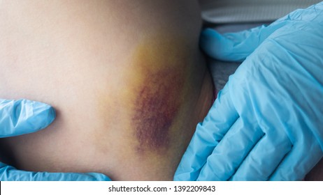 Closeup On A Bruise On Wounded Woman Leg Skin. Gender Violence Concept. Doctor In Gloves And Patient. Split Or Stretching Injury. 