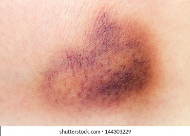 Closeup On A Bruise On Wounded Woman Leg Skin