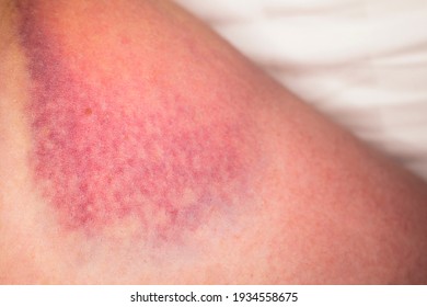 Closeup On A Bruise On Wounded Woman Leg Skin. Close Up On A Bruise On Wounded Woman Leg Skin. Gender Violence Concept. Damage To The Integrity Of Blood Vessels, Hematoma From A Strong Blow