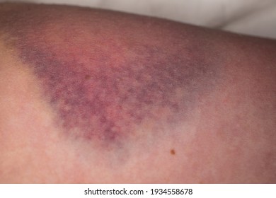 Closeup On A Bruise On Wounded Woman Leg Skin. Close Up On A Bruise On Wounded Woman Leg Skin. Gender Violence Concept. Damage To The Integrity Of Blood Vessels, Hematoma From A Strong Blow