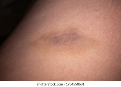 Closeup On A Bruise On Wounded Woman Leg Skin. Close Up On A Bruise On Wounded Woman Leg Skin. Gender Violence Concept. Damage To The Integrity Of Blood Vessels, Hematoma From A Strong Blow