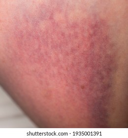 Closeup On A Bruise On Wounded Woman Leg Skin. Close Up On A Bruise On Wounded Woman Leg Skin. Gender Violence Concept. Damage To The Integrity Of Blood Vessels, Hematoma From A Strong Blow