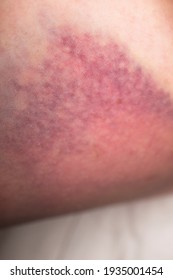 Closeup On A Bruise On Wounded Woman Leg Skin. Close Up On A Bruise On Wounded Woman Leg Skin. Gender Violence Concept. Damage To The Integrity Of Blood Vessels, Hematoma From A Strong Blow