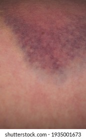 Closeup On A Bruise On Wounded Woman Leg Skin. Close Up On A Bruise On Wounded Woman Leg Skin. Gender Violence Concept. Damage To The Integrity Of Blood Vessels, Hematoma From A Strong Blow