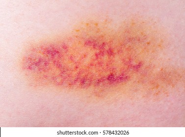 Closeup On A Bruise On Wounded Woman Leg Skin