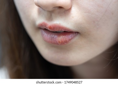 Close-up On Herpes On Asian Woman Lips