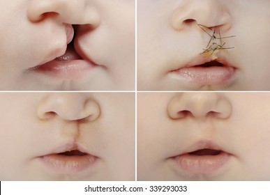 Closeup On Lips Of Baby With Lip And Palate Cleft Before And After Surgery. 