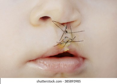 Closeup On Lips Of The Baby With Lip And Palate Cleft Right After Surgery 