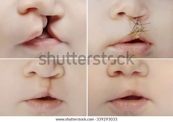 Closeup on lips of baby with lip and palate cleft before\
and after surgery. 