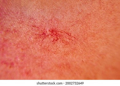 Close-up On The Skin Of The Girl's Face Are Visible Couperose, Red And Dilated Capillaries, Spider Veins, Vascular Problems