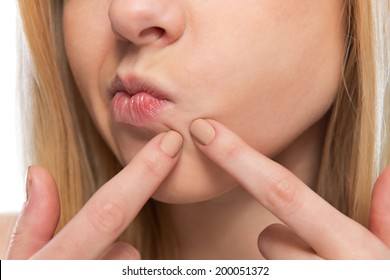 Closeup on teenager poping pimple