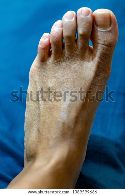 corn on second toe