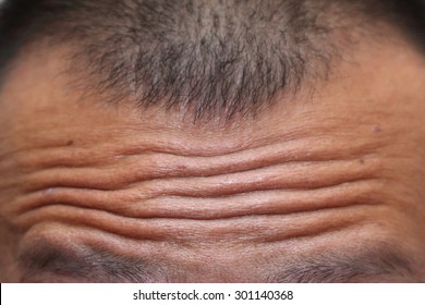 Close-up On Wrinkled Forehead