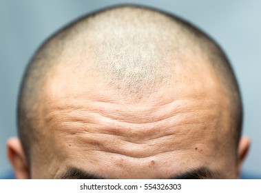 Close-up On Wrinkled Forehead