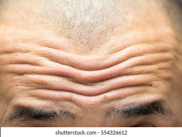 Close-up On Wrinkled Forehead