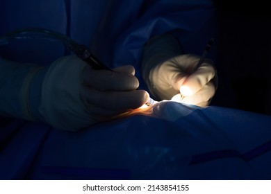 Close-up Of Ophthalmologist's Hands Operating On A Cataract, With An Irrigation And Aspiration Probe And An Aid Stick. Sterile Gloves And Blue Surgical Gown.