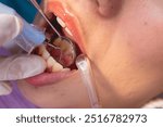 Closeup of an oral prophylaxis or dental cleaning procedure. A dental scaler is being used to remove plaque or tartar from the back of incisors, while a saliva ejector keeps the area dry.
