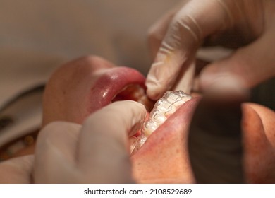 Close-up of an orthodontic specialist adjusting and placing invisible aligners on a Latina woman. Concept of invisible orthodontic technique.