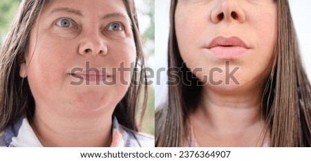 close-up part of female face of woman 40-50 years old with age wrinkles, facial wrinkles before and after treatment, concept of cosmetics, lip augmentation, correction surgery, cosmetic procedures [[stock_photo]] © 