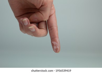 Closeup Of A Person Applying Vaseline (petroleum Jelly) On Their Hand.