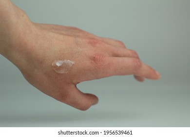 Closeup Of A Person Applying Vaseline (petroleum Jelly) On Their Hand.