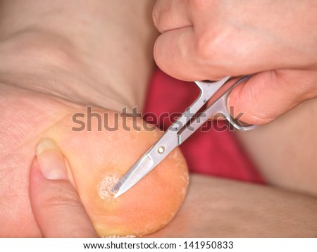 Closeup of person treating callus on heel with scissors
