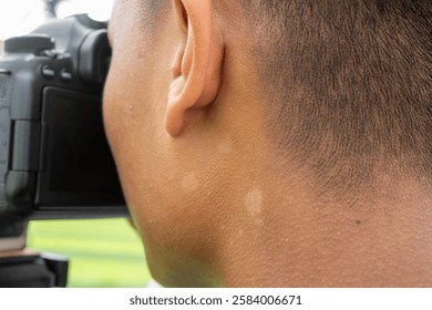 Close-up of a person's ear and neck while holding a DSLR camera with tinea versicolor in pityriasis versicolor, highlighting skin texture and camera detail in an outdoor setting.