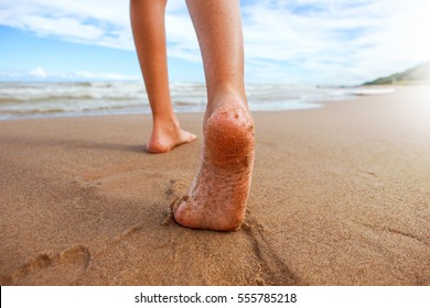 Closeup of a person's feet walking on the beach, focus on arch of foot - Powered by Shutterstock