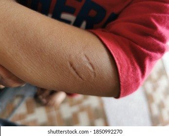 A Closeup Photo Of A Bite Mark On A Little Boy Arm