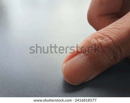 Close-up photo of a hand showing the thumb nails and the skin around the nails
