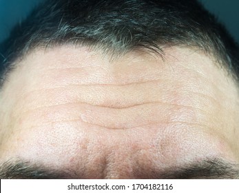 Closeup Photo Of A Male Forehead With Deep Wrinkles And Pores