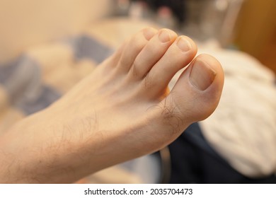 Close-up photo of a male left foot with long toenails and varus big toe.