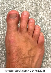 Closeup photo of Morton’s toe