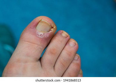 Close-up Photo Of A Toenail Infection In Human	