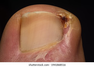 Close-up Photo Of A Toenail Infection In Human	