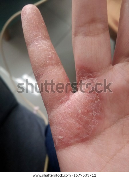 アトピー性湿疹を持つ若い女性の小指 ピンキーの接写 手の皮膚炎 の写真素材 今すぐ編集