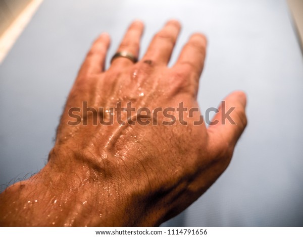 excessive hand sweating