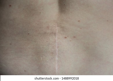 Close-up Photography Of A Surgery Scar On The Back