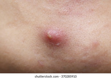 Close-up Pimple On A Man Skin